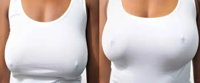 Sagging Breasts vs Firm Breasts