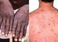 MonkeyPox