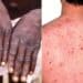 MonkeyPox