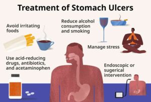Natural Remedies To Cure Stomach Ulcers